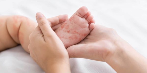 Ikuti Cara Menyembuhkan Alergi Gatal Pada Kulit Anak